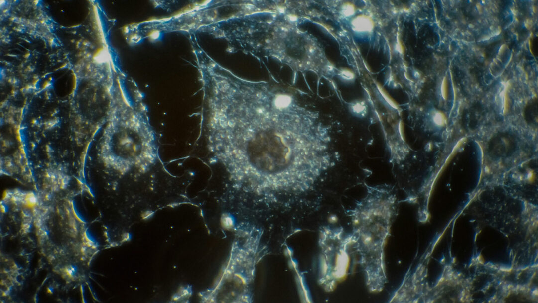 Solid tumors